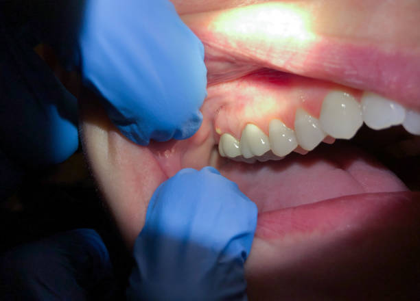 Best Emergency Dental Care for Sports Injuries in Centerville, IN